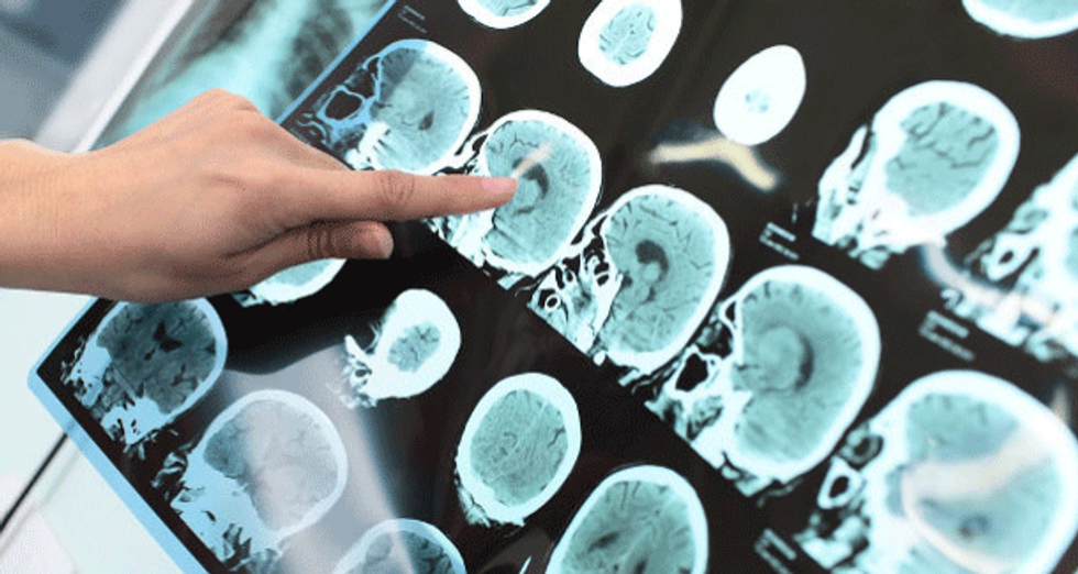 parodontite alzheimer