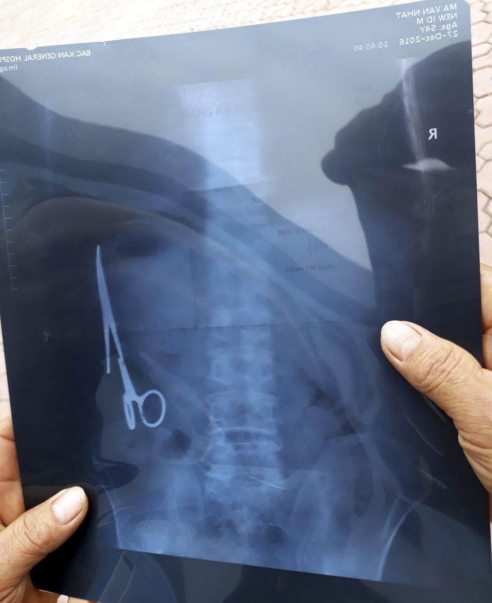 Pas 18 vitesh i nxorën nga barku gërshërët e harruara gjatë operimit foto 2