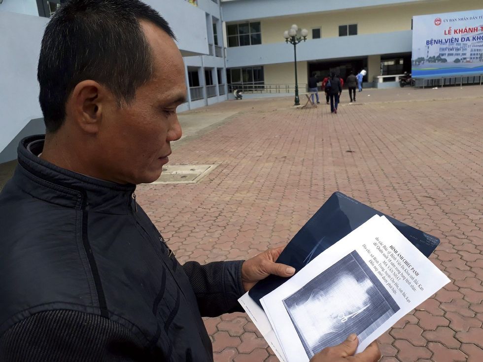 Pas 18 vitesh i nxorën nga barku gërshërët e harruara gjatë operimit foto 3