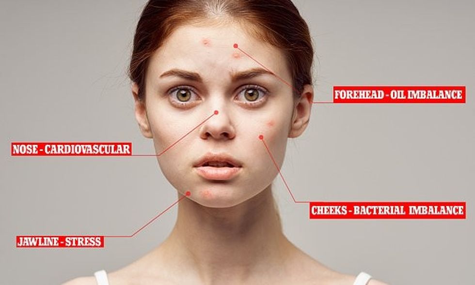 pcos symptoms pcos and acne featured image
