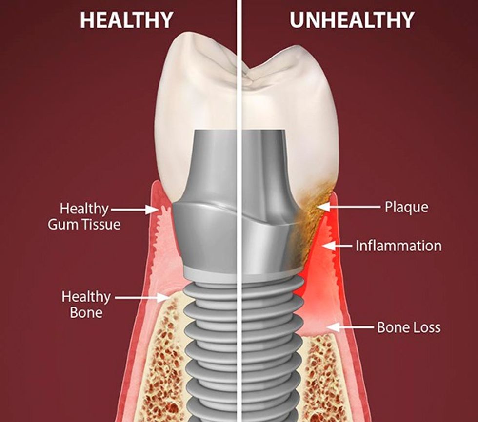 peri implantitis