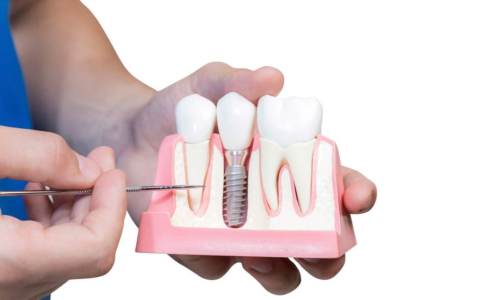 Peri implantitis657