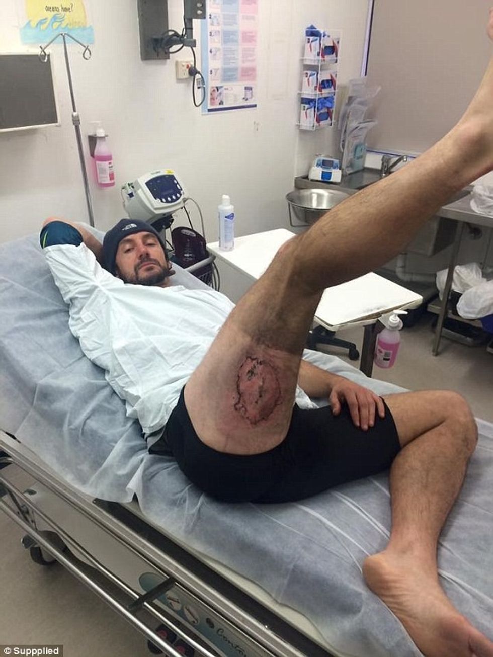 Pëson djegie të shkallës së tretë pasi i eksplodon iPhone dhe i kapet per trup foto 2