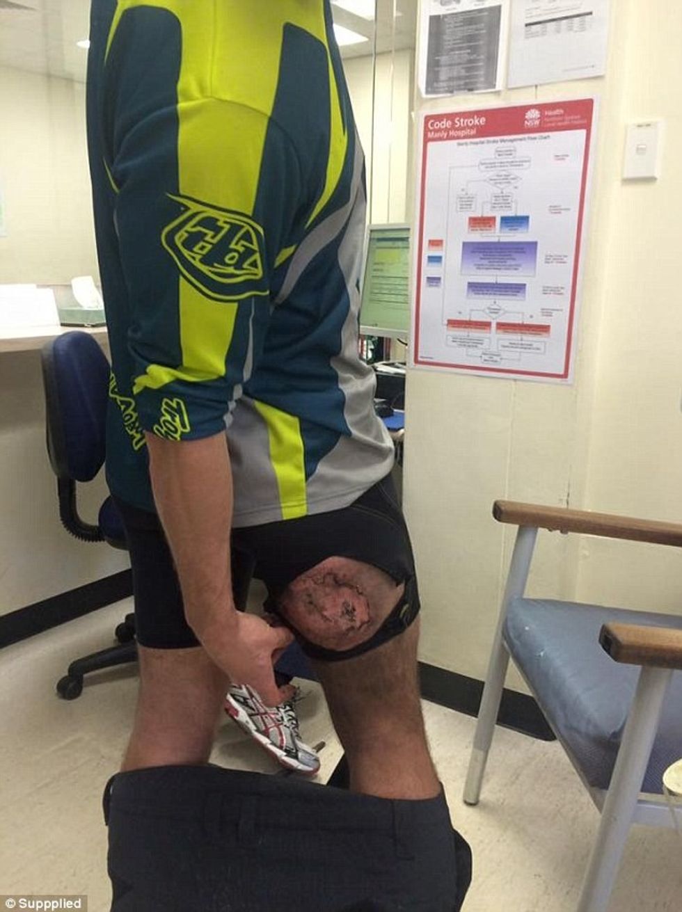 Pëson djegie të shkallës së tretë pasi i eksplodon iPhone dhe i kapet per trup foto 3