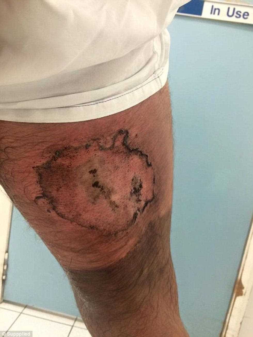 Pëson djegie të shkallës së tretë pasi i eksplodon iPhone dhe i kapet per trup foto 4