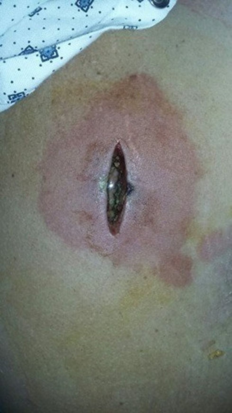 Pickimi i merimangës së vogël i shkaktoi pasoja serioze dhe te dhimbshme foto 2