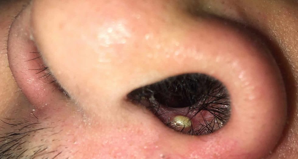 pimple in nose 1