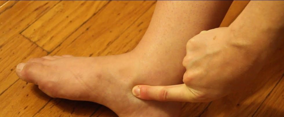 pitting edema severe pitting
