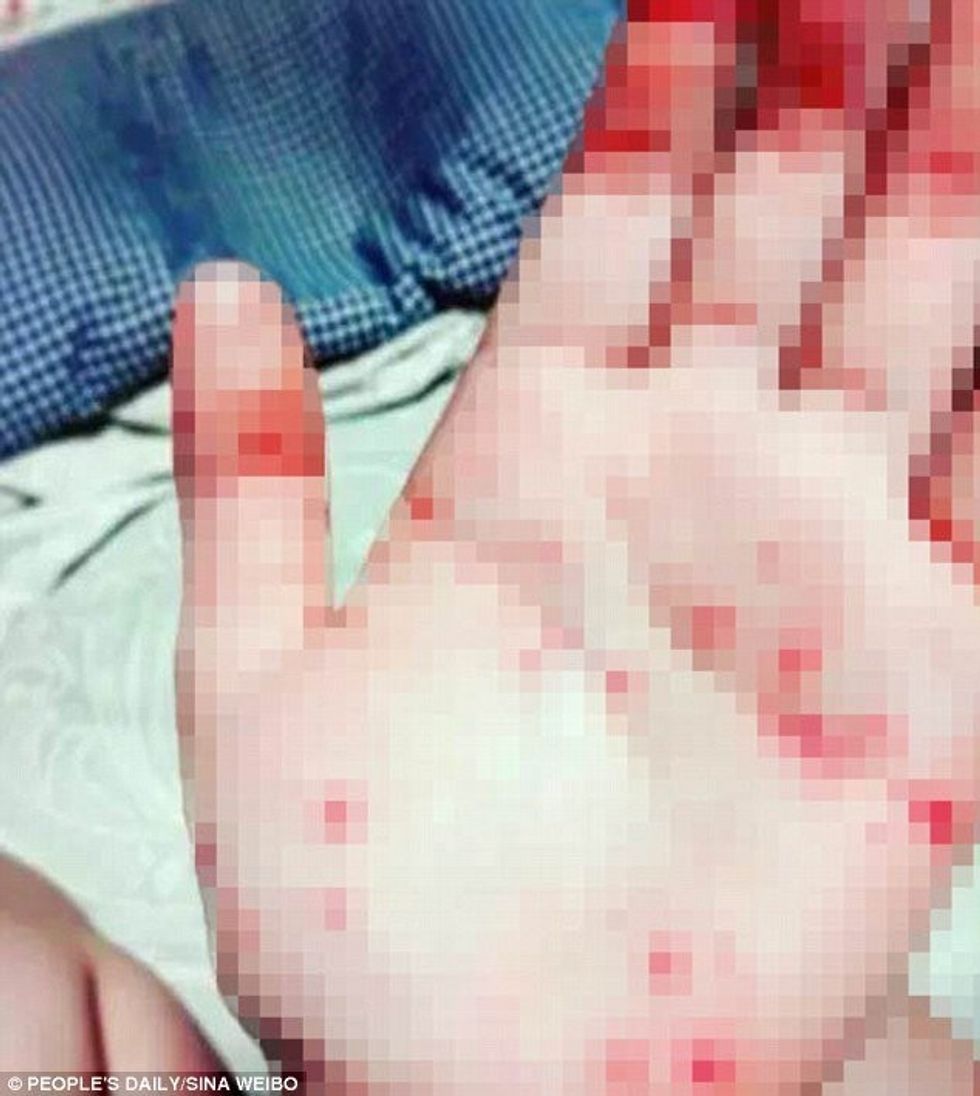 Platforma e ngjashme me Balenen e Kalter detyron femijet te bejne qepje ne lekuren e tyre foto 2