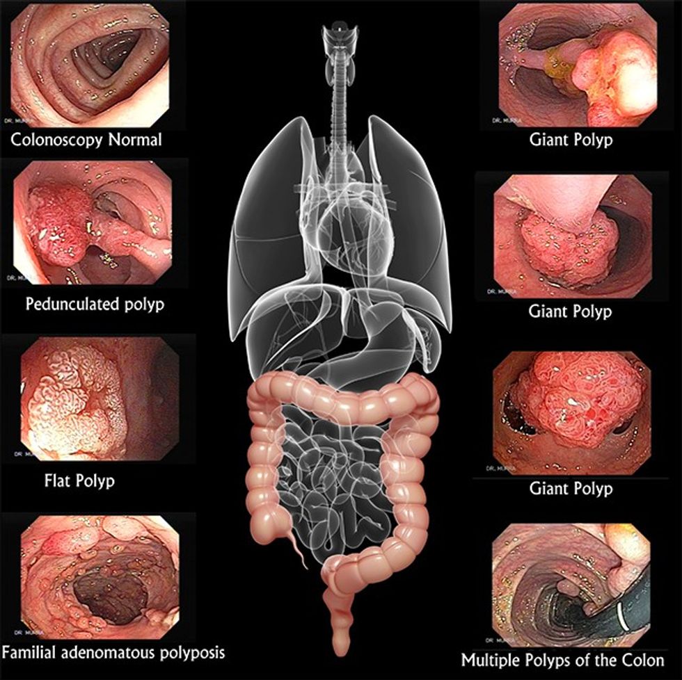Polypsofthecolon