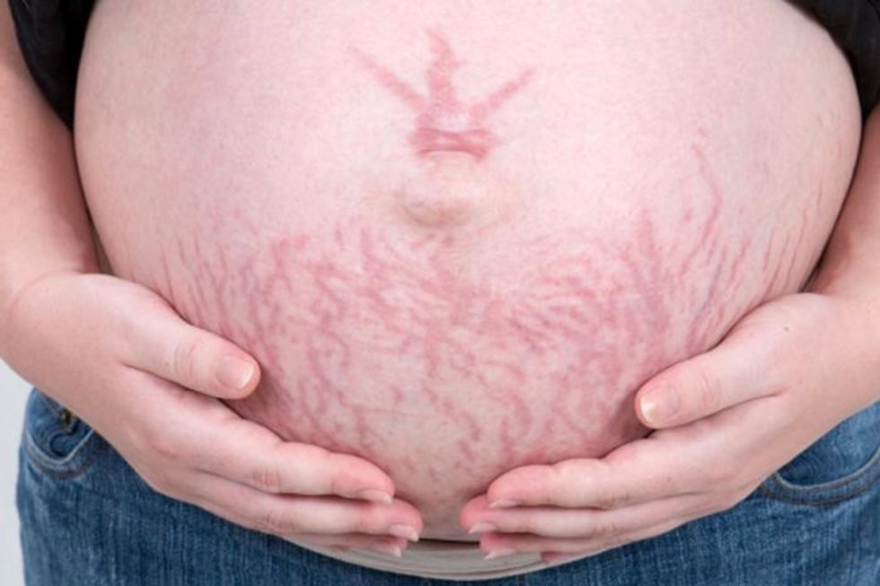 pregnant woman with stretch marks
