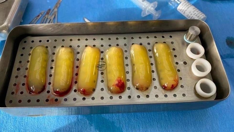 PRF Platelet Rich Fibrin Made from Patients Blood