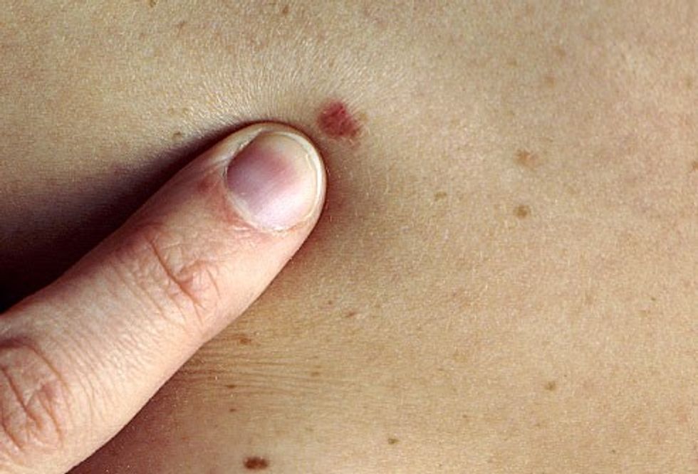 PRinc photo of skin cancer screening