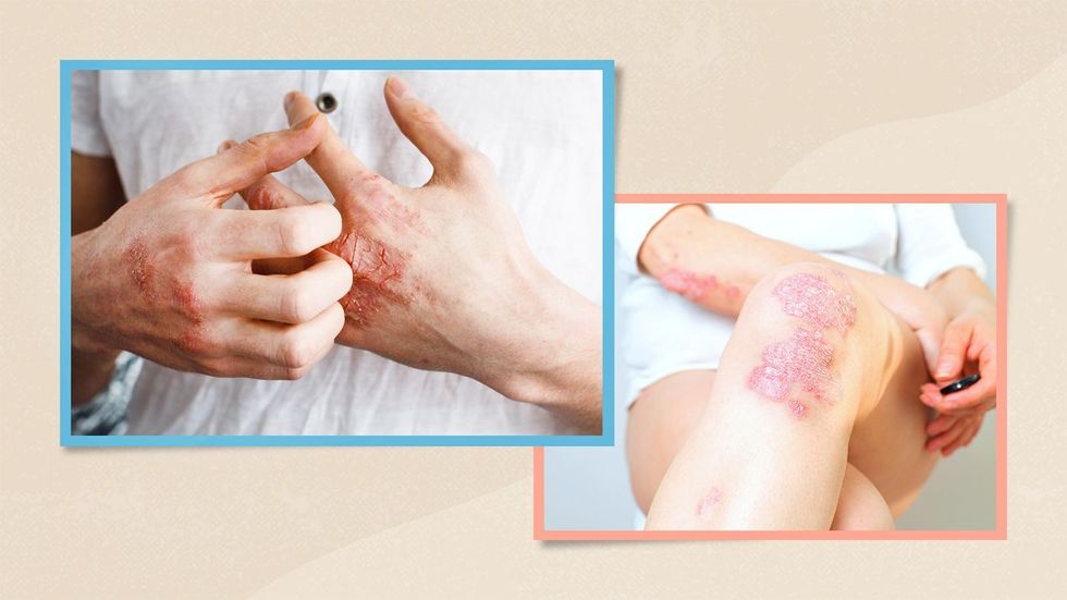 psoriasis in women vs men 1