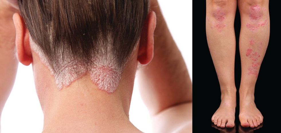 psoriasis scalp