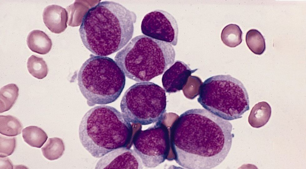 Qeliza te papjekura apo kanceroze ne strishon periferike