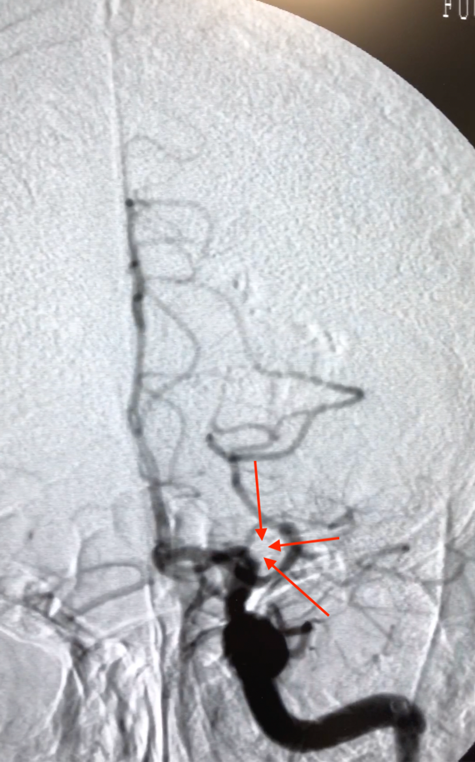 rasti dy okludim i ACM majtas maja e shigjtave
