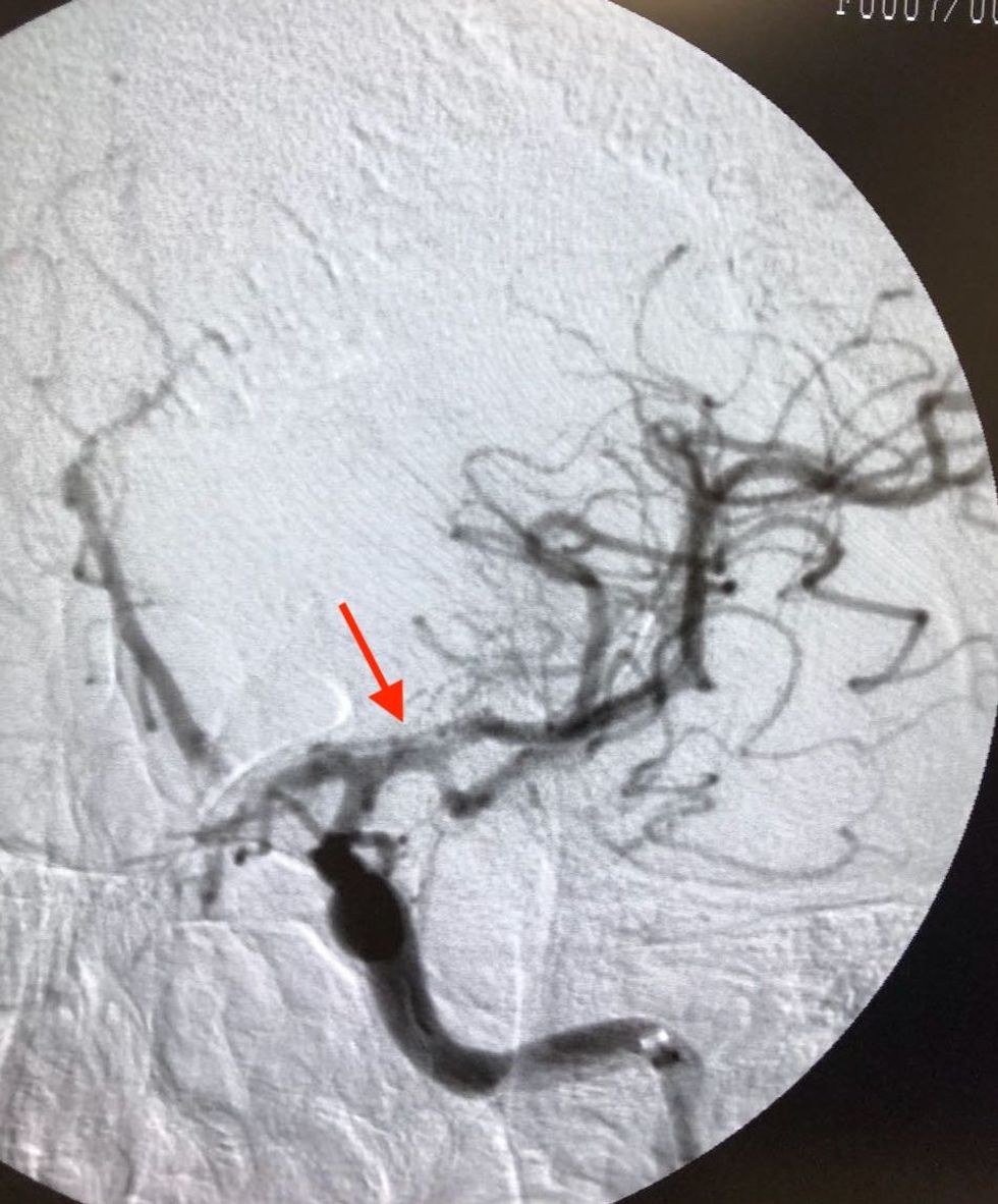 rasti i dyte acm majtas e rekanalizuar