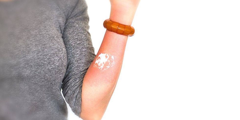 remedy bee sting relief