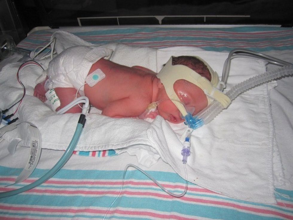 Respiratory Distress Syndrome In Newborns