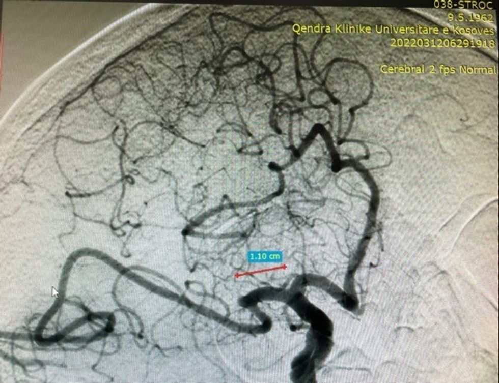 Rikanalizim i arteries trunore te mesme djathtas