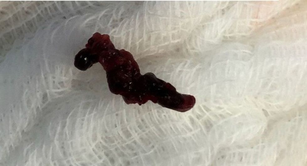 rombi i nxjerre me trombektomi mekanike n