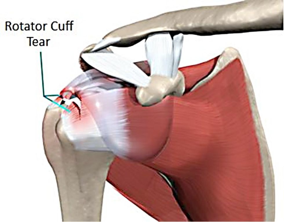 rotatorcuff 2(1)