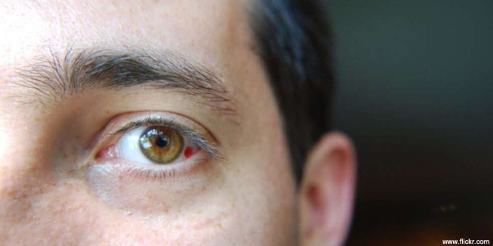 Ruptured Blood vessel in a young mans eye