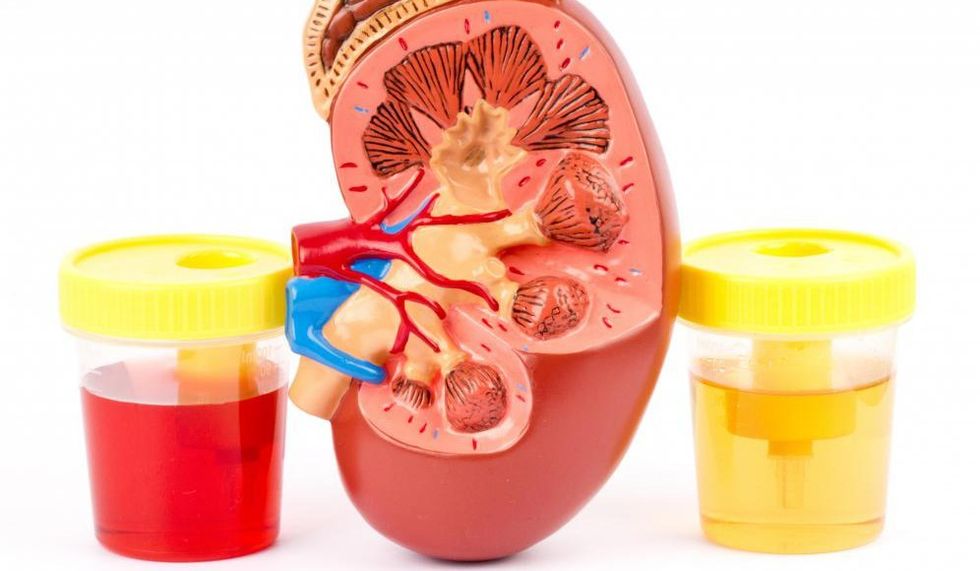 sangre en la orina hematuria e1451740204447