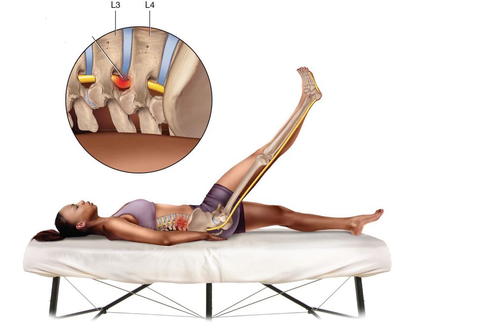 Sciatica Blog Photo 3