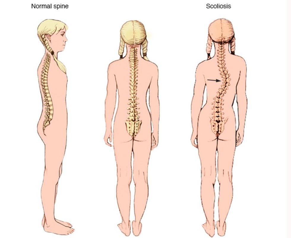 _scoliosisthu_jpg