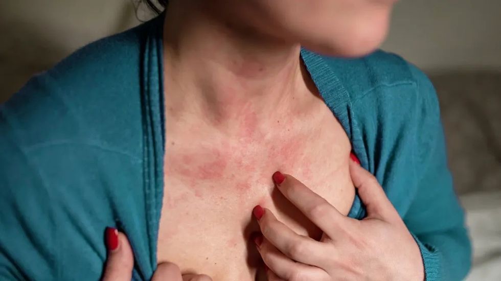 scratching itchy chest hives header