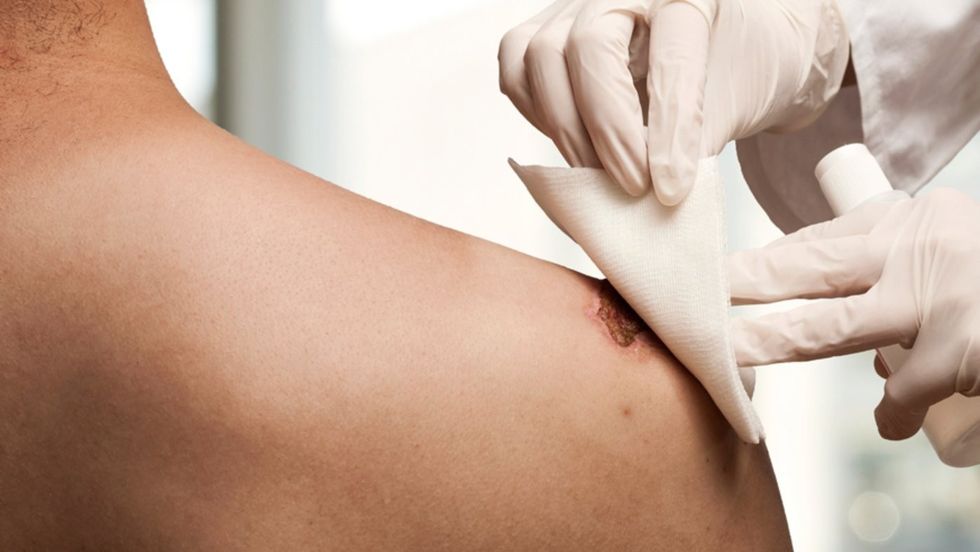 Sepsis Shoulder HN402 Injury iStock000049735102 Sized