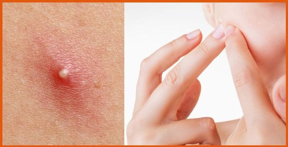 Should I pop out my white head pimples