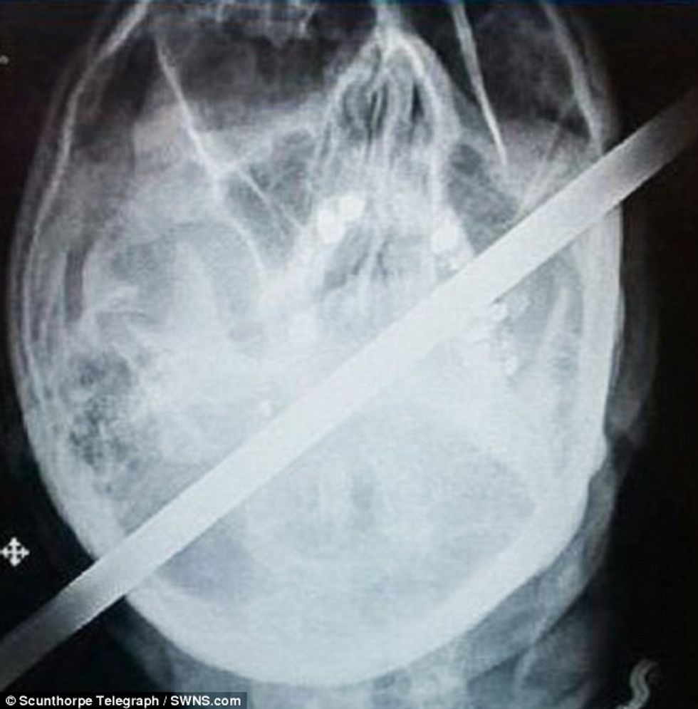 Shpëton mrekullisht pasi shpohet ne fyt nga nje shufer metalike foto 2