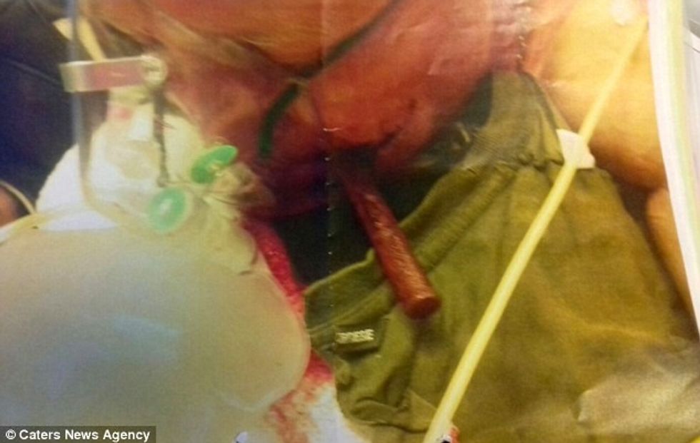 Shpëton mrekullisht pasi shpohet ne fyt nga nje shufer metalike foto 3