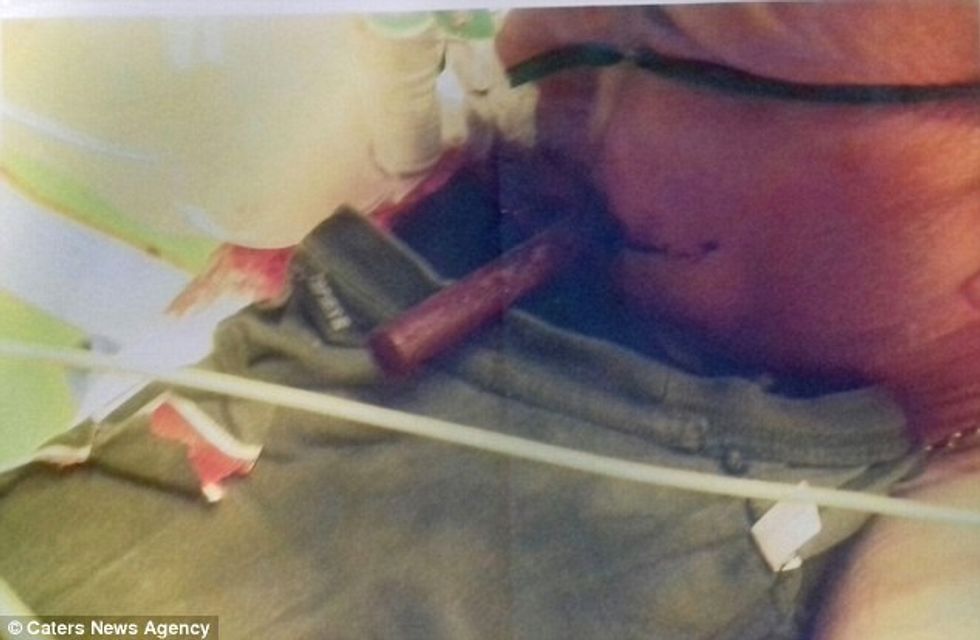 Shpëton mrekullisht pasi shpohet ne fyt nga nje shufer metalike foto 4