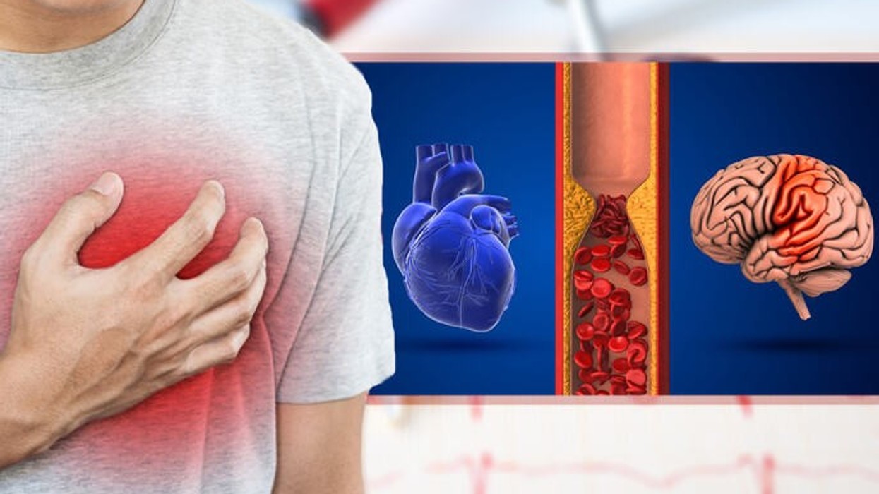 Fibrilacioni atrial dhe goditja në tru: Sa mund të ndihmojë aktiviteti fizik