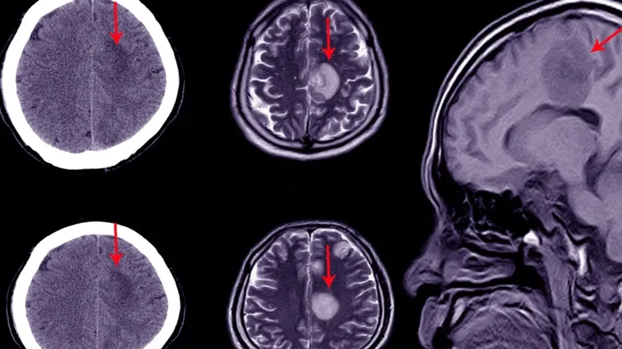 Një ndërhyrje e thjeshtë që ul ndjeshëm rrezikun e gjakderdhjes në tru pas operacionit