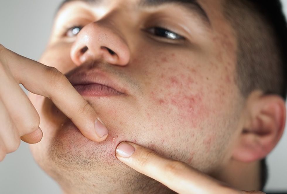Single Img What Causes Beard Pimples 5f40db1b35c57