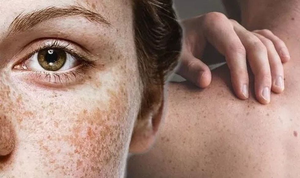 Skin cancer Freckle signs 1412597