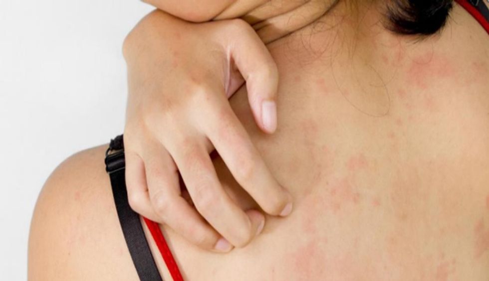 Skin-Rashes-Due-To-Vitamin-B-Overdose