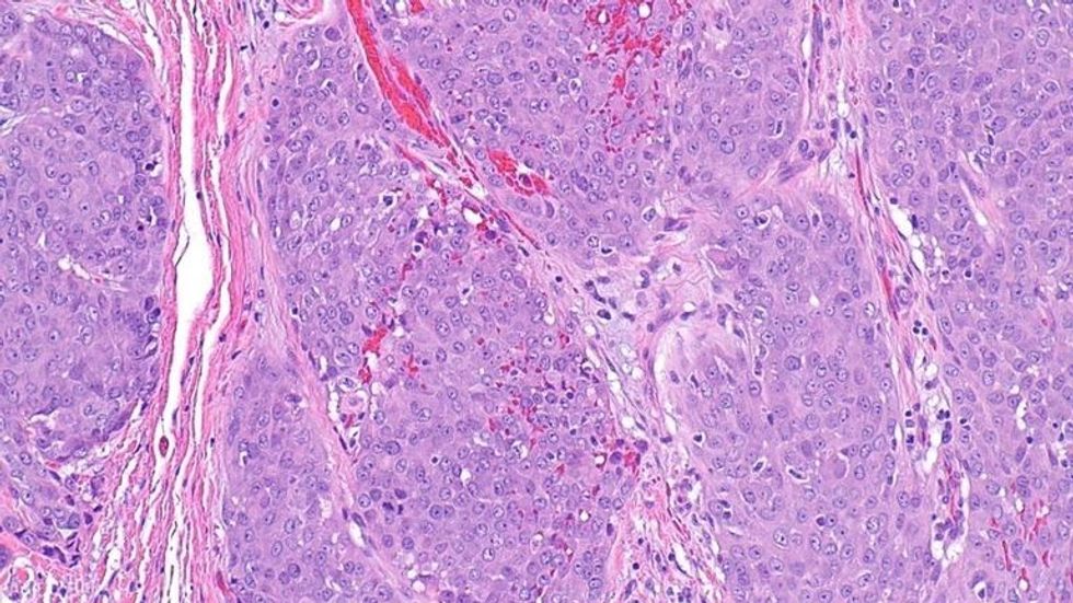 skynews cancer treatment herpes 5908330