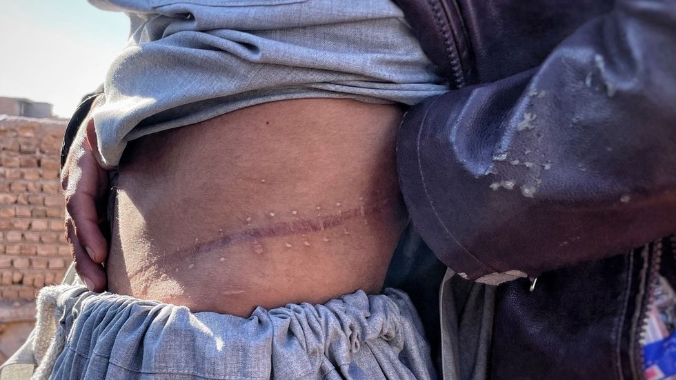 skynews kidney transplant scar 5653262