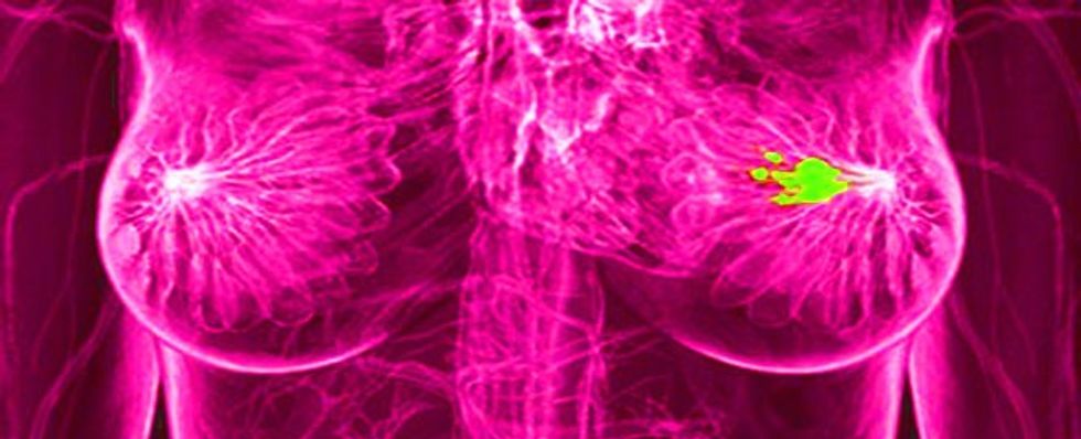 Slider669 272 BLOG breastcancer microbiome probiotic