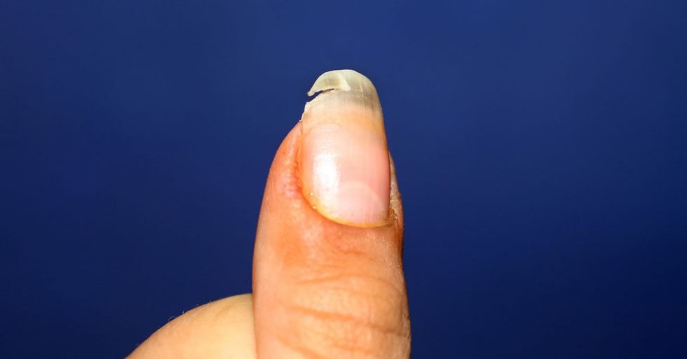 Split Fingernail Facebook 1
