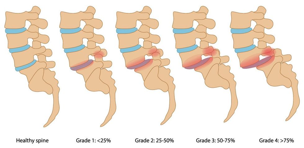 spondylolisthesis stages 1