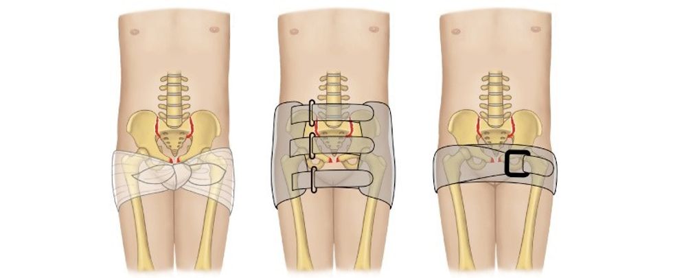 Stabilizimi i pelvikut