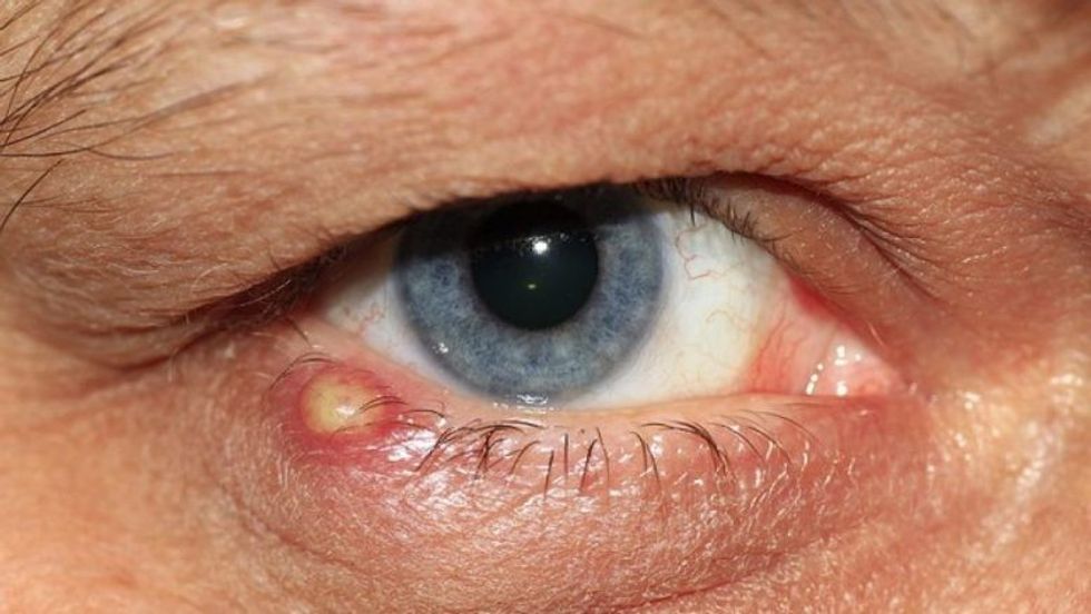 Stye in the eye 1