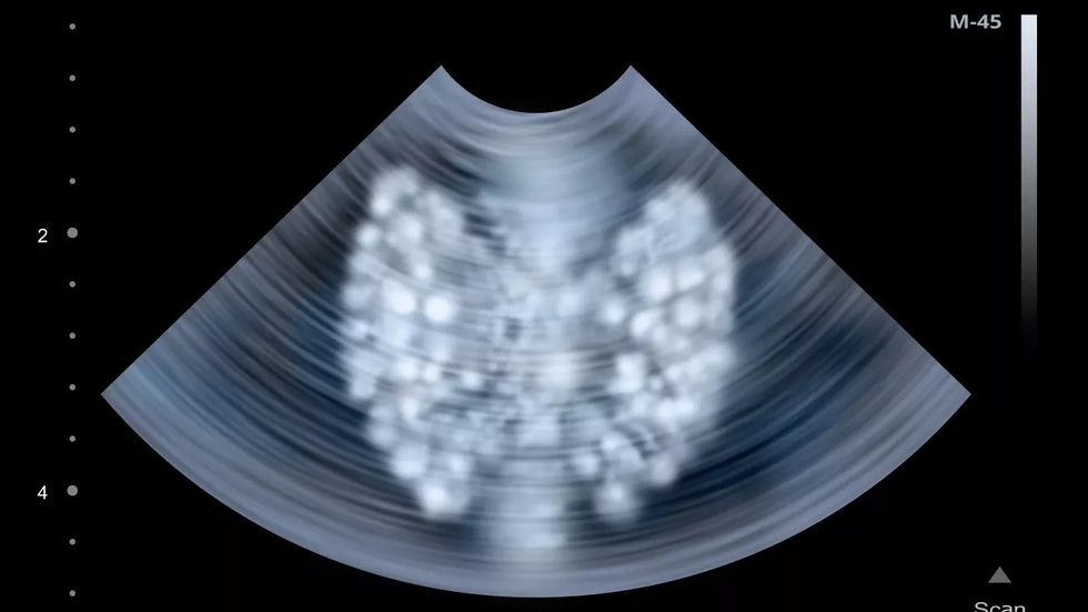 thyroid ultrasound adobestock 94381119